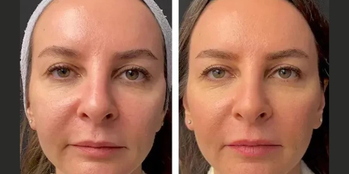 How Best Aesthetic Clinic in Dubai Uses Mesotherapy for Skin Hydration