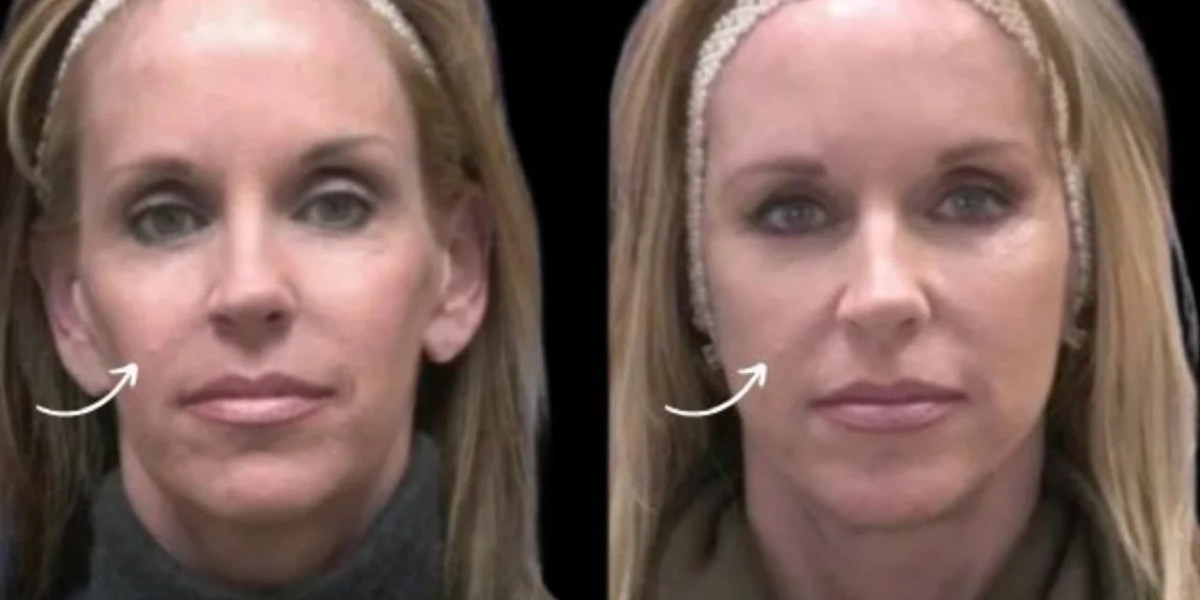 Sculptra in Dubai for Chin Skin Texture
