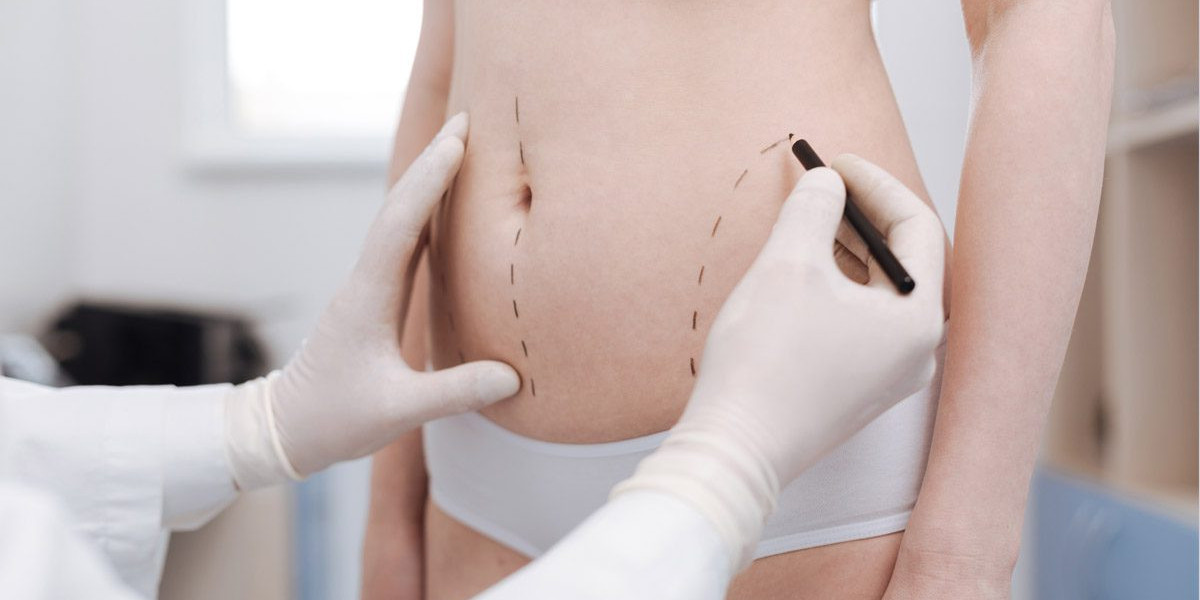 Best Liposuction Surgeon in Dubai Innovative Techniques for Refined Contours