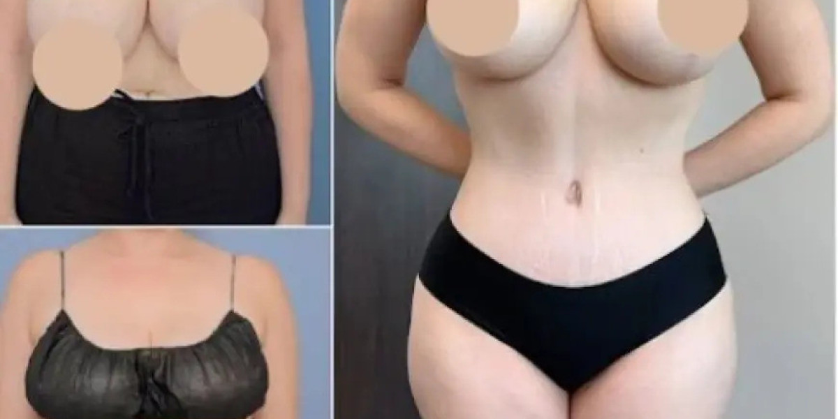 Tummy Tuck in Dubai: A Trusted Choice for Body Rejuvenation