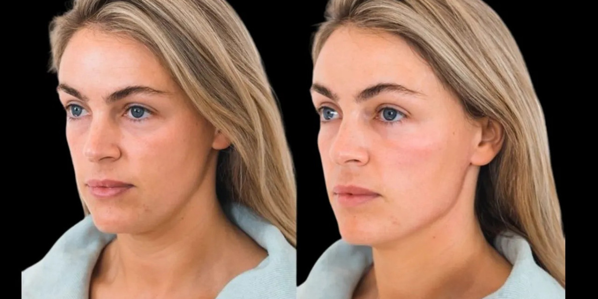 Best Doctors in Dubai for Anti-Aging Cheek Fillers