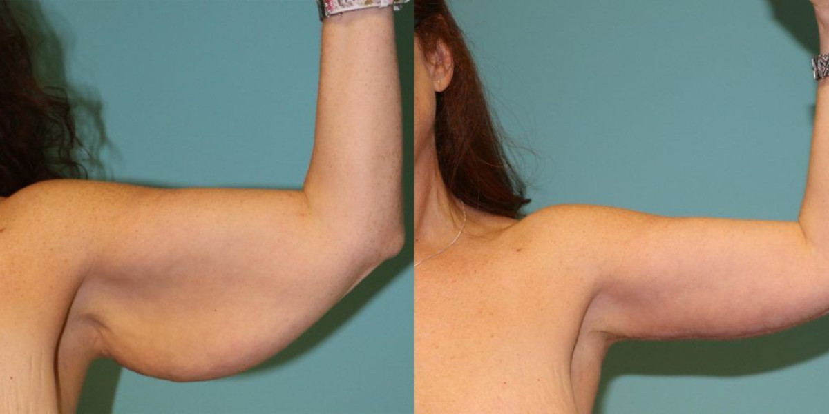 Arm Lift Surgery in Dubai: Understanding Scars