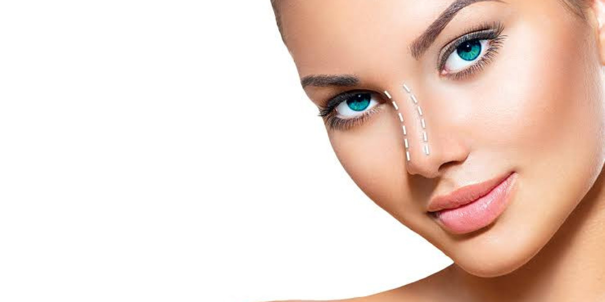 Can Alarplasty achieve nasal proportions for natural elegance?