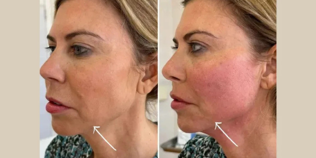 Best Doctors in dubai for Endolift Treatments with Natural Results