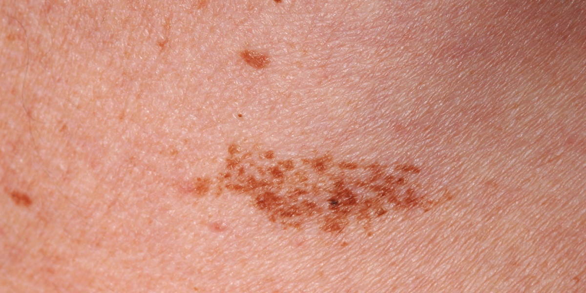 Who is a good candidate for Birthmarks Removal?