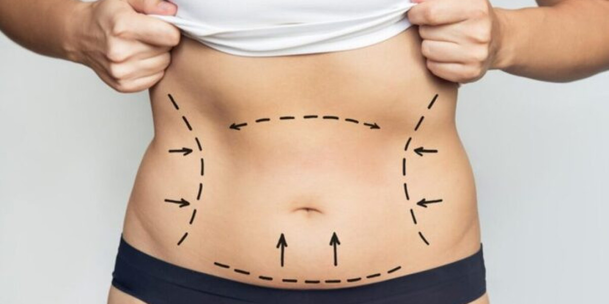 Best Doctors in Dubai for Liposuction Exploring Techniques for Body Sculpting