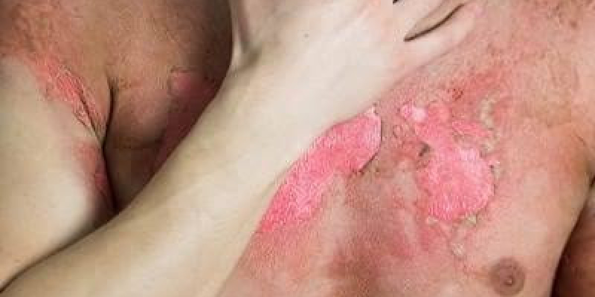 What Happens During Burn Reconstructive Surgery in Islamabad?