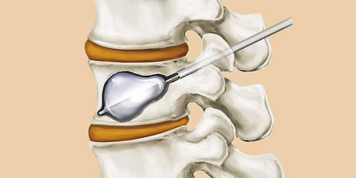 Details of Kyphoplasty Procedure in Mesquite for Spinal Fractures