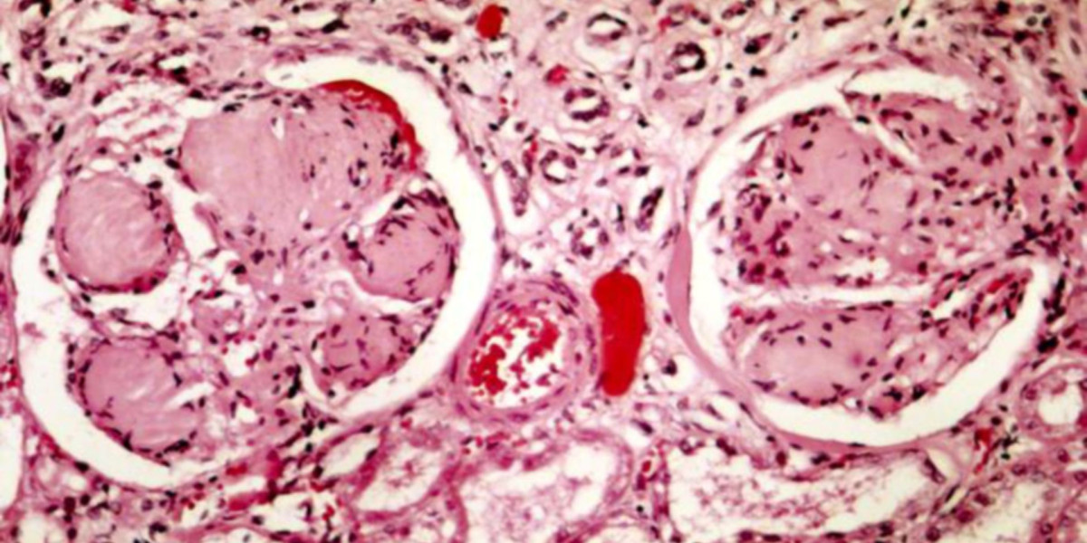 What Is Minimal Change Kidney Disease and What Are the Causes of Nephrotic Syndrome?