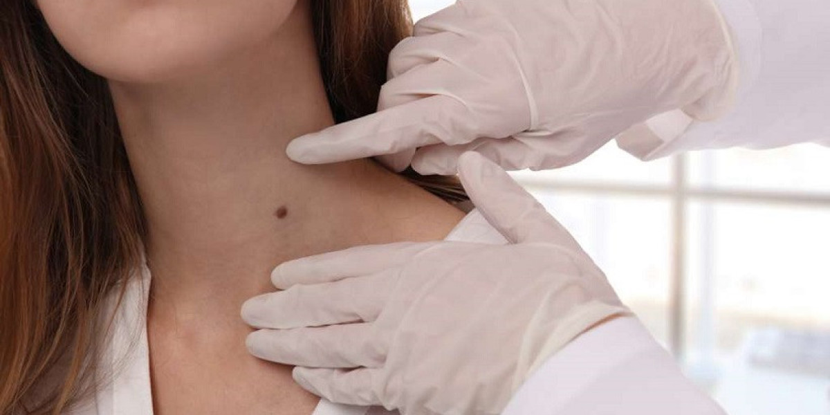 Does mole removal cost depend on mole size?