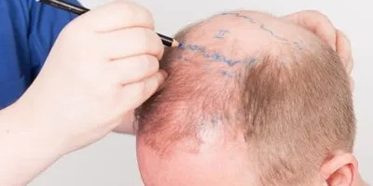 Why Riyadh is a Leading Destination for Hair Transplant Treatments