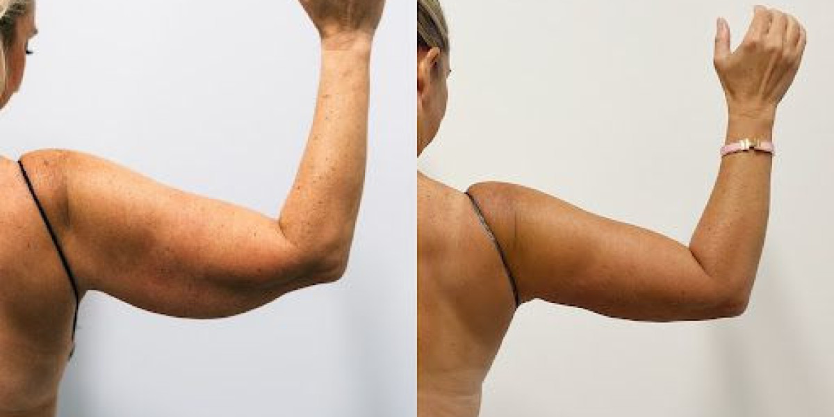 Arm Lift Surgery in Dubai: Your Treatment Journey