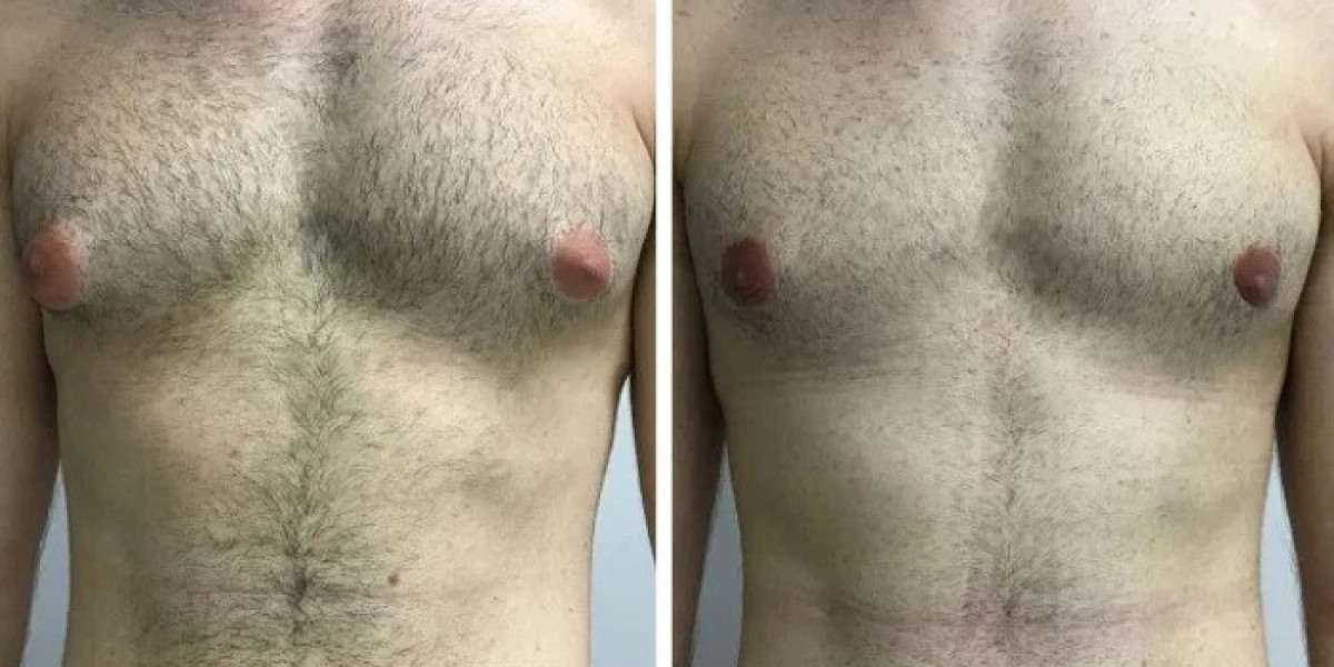 Best Doctors in Dubai Explain Gynecomastia After Weight Loss