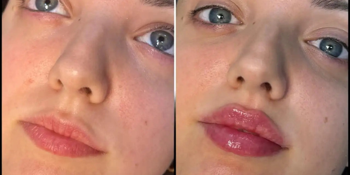 Dermal Fillers by Best Doctors in Dubai for Youthful Skin