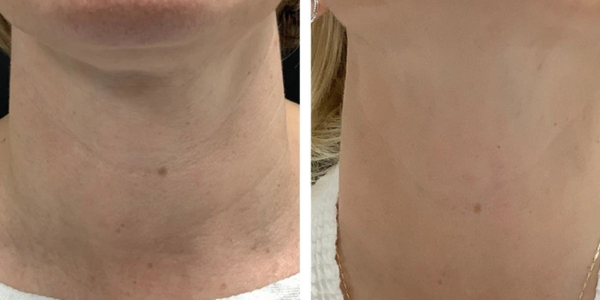 Radiofrequency (RF) Microneedling in Dubai for Long-Term Skin Improvement