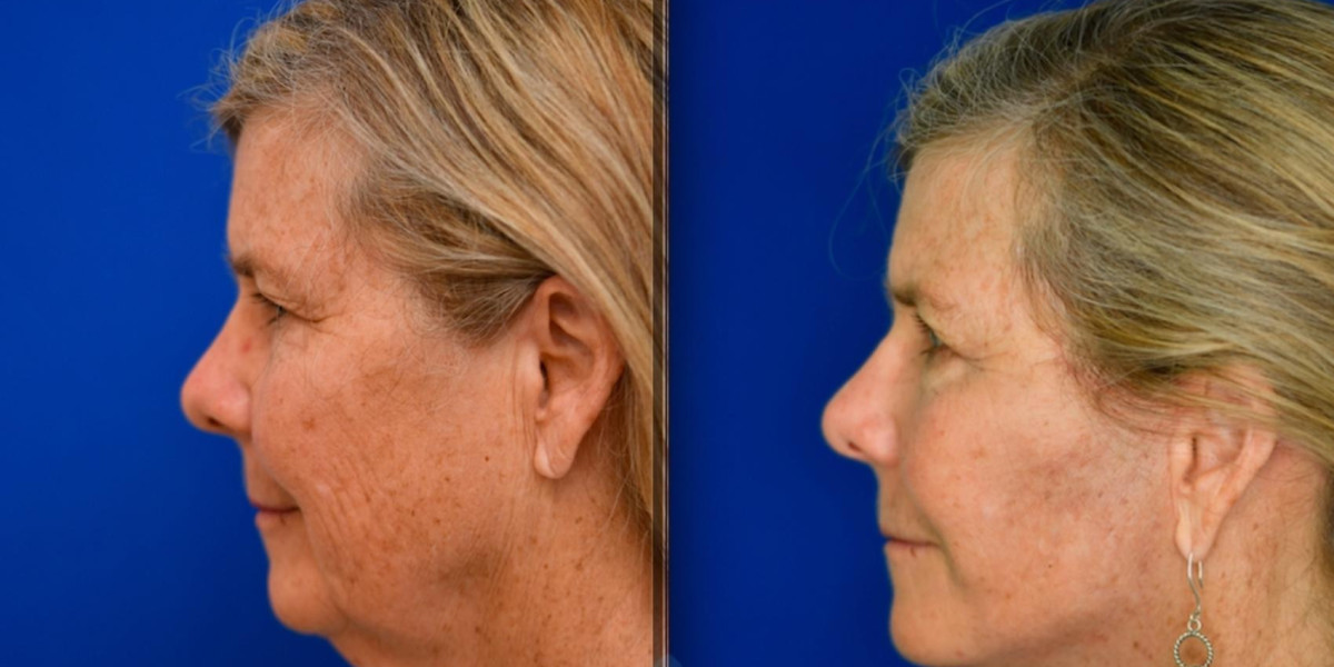 Neck Lift surgery in Dubai: Key Facts to Know