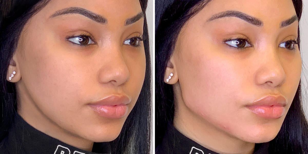 Brow Lift Surgery in Dubai: Is It Right for You?