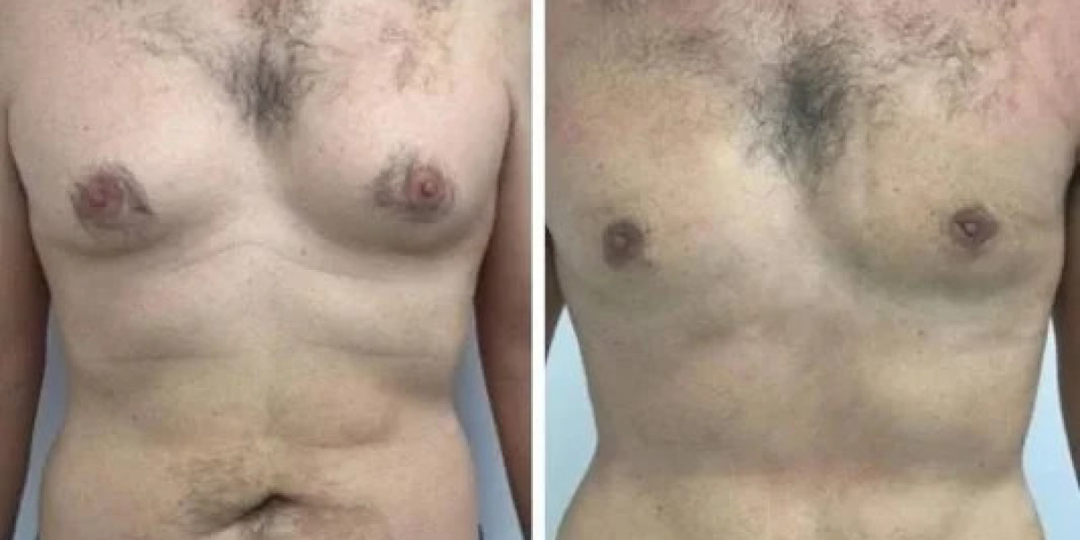 Gynecomastia in Dubai: Safe and Effective Treatment Options