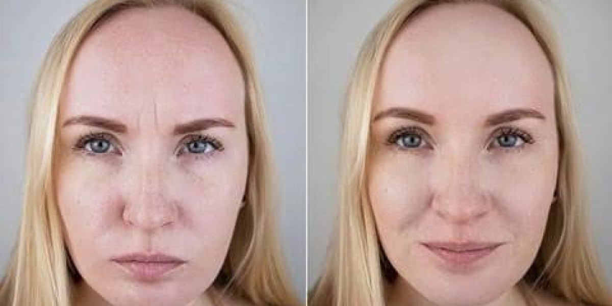 Allergan Botox in Dubai: Treatment Process