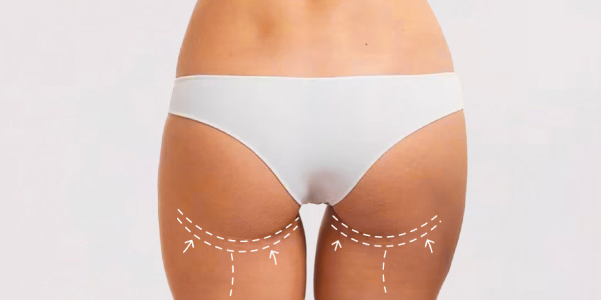 Buttock Augmentation in Dubai: Treatment Options