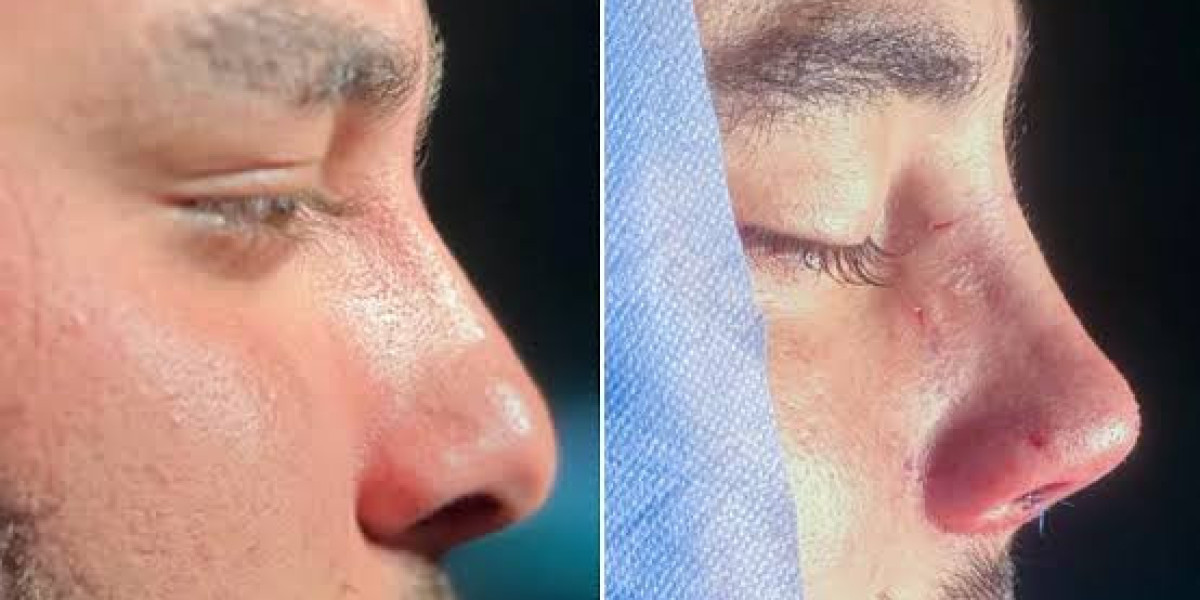 What Should Men Know Before Choosing Male Rhinoplasty in Islamabad?