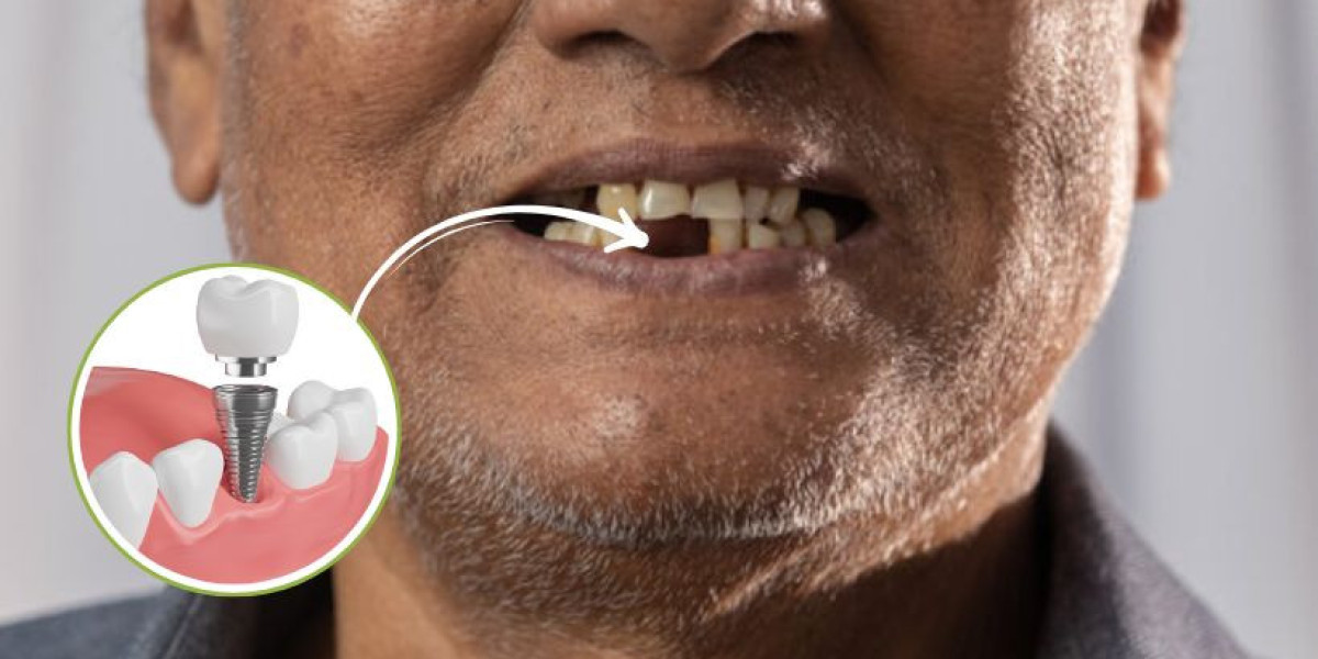Which type of dental implant is best?