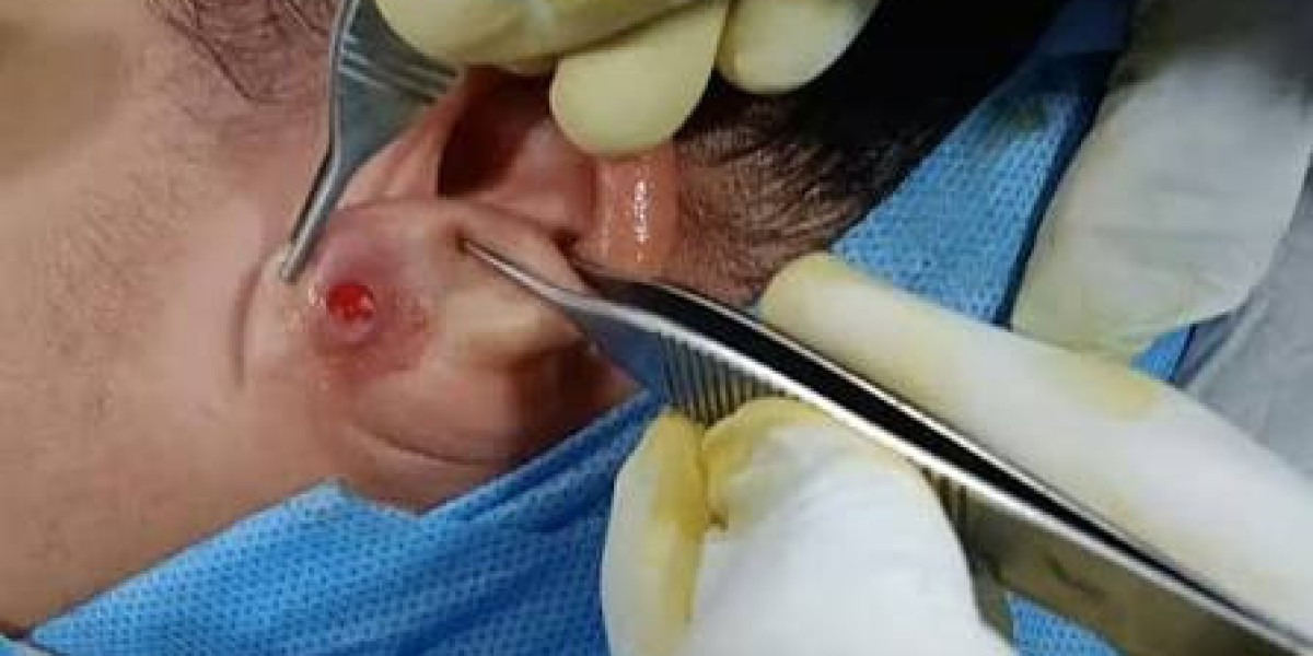 Is Earlobe Correction Surgery in Islamabad Painful During and After Treatment?